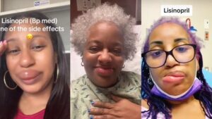 Why Black Folks’ Lips Swelling Dramatically? Doctors Say It’s These Meds